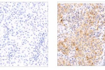 מדענים גילו גן חדש שמוטציה שלו גורמת לסרטן